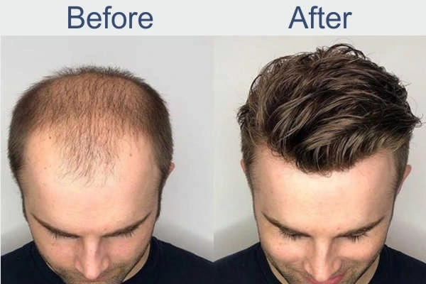 Full Lace Hair Patch